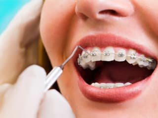 SEO Blog Writing for Orthodontist
