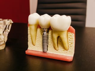 Top 6 Benefits of Dental Implants | LandMark Dentistry