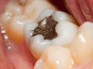 Dental Fillings: Procedure, Colors, Materials, and More