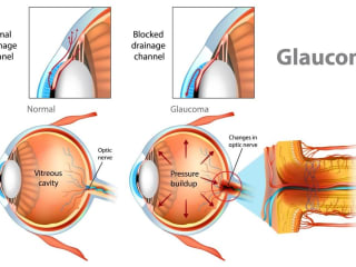 Glaucoma Empowerment Guide: Symptoms, Causes, and Treatment