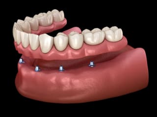 What Is A Lower Denture Stabilizer? - LandMark Dentistry