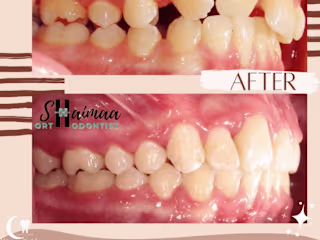 @moonlightdentalcenter on Instagram‎: ”عدم انتظام الأسنان قد ي…