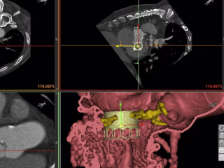 Mitral Valve Planner