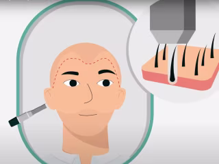 FUE Hair Transplant - Expaliner videos