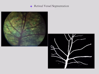 Retinal Vessel Identification and Disease Detection