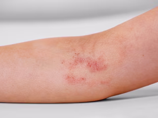 Atopic Dermatitis: A Personalized Approach May Improve Outcomes