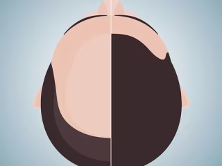 Hair Transplant