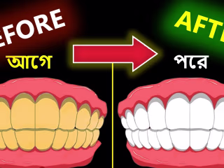 Make Yellow Teeth Sparkle Pearly White at Home (Easy)