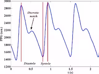 Healtrust: Wearable device for post-operatory monitoring.