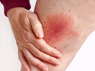 NIAID funds Post-Treatment Lyme Disease Syndrome research
