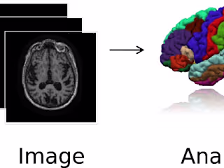 How Machine Learning is Powering Neuroimaging to Improve Brain …