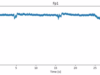 Probabilistic Classification of Epileptic Patterns