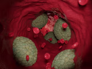 Taking Statins to Reduce Cardiovascular Disease in T2 Diabetics