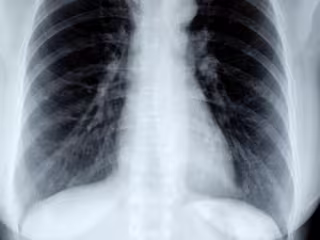 Pneumonia Classification for Covid-19