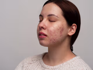 Accutane | How It Works | What To Expect During Treatment