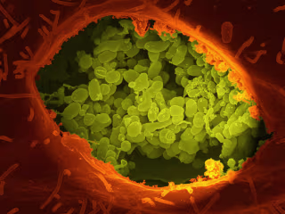 Endocarditis in Intravenous Drug Users: A Dangerous Infection