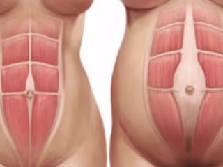 Abdominal Separation Blog