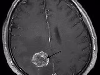BRAIN TUMOR - MosiPhysio