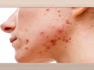 Treating Cystic Acne Blog Entry