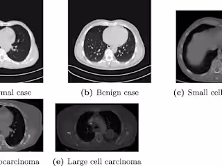 Lung Tumor Detection and Recognition Using Deep Learning in CNN
