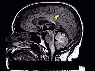 Death following rapidly progressive demyelinating disorder in a…