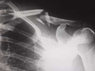 What Injuries Do Robert J. DeBry Car Accident Lawyers Accept?