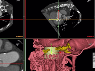 Mitral Valve Planner