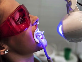 Teeth Whitening vs. Dental Veneers