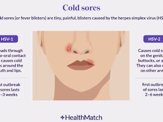 Writing: Herpes: An Unexpected Cancer Therapy