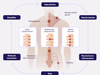 Writing and Researching: When Painkillers Make Back Pain Worse