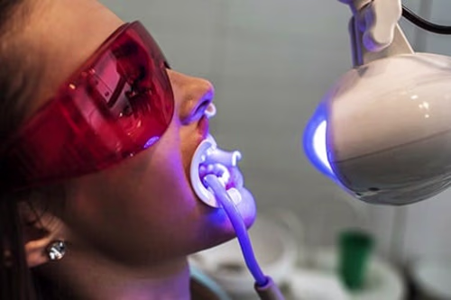 Teeth Whitening vs. Dental Veneers