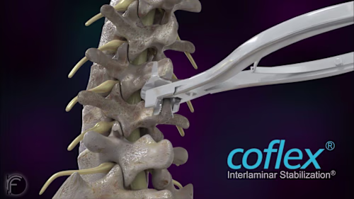 Coflex Medical Device Animation - YouTube