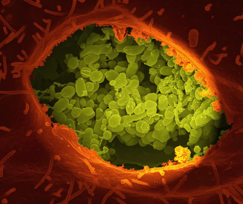 Endocarditis in Intravenous Drug Users: A Dangerous Infection
