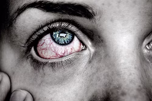 How to Cope With Conjunctivitis (Apollo)