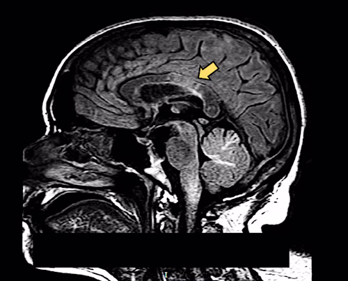 Death following rapidly progressive demyelinating disorder in a…