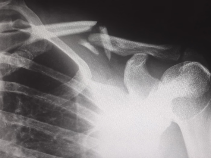 What Injuries Do Robert J. DeBry Car Accident Lawyers Accept?