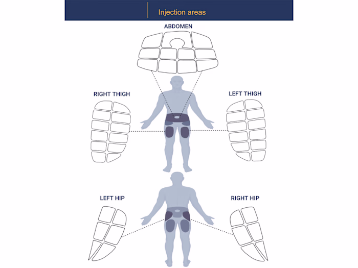 An illustration of injection areas