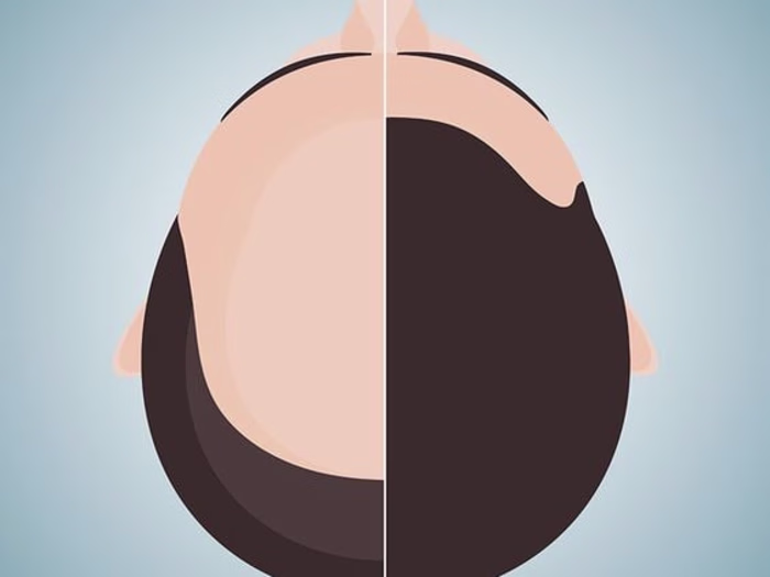 Hair Transplant