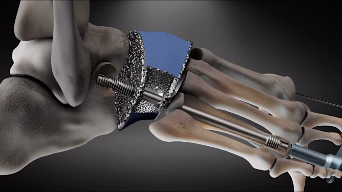 Medical 3D animation. Charcot foot implant