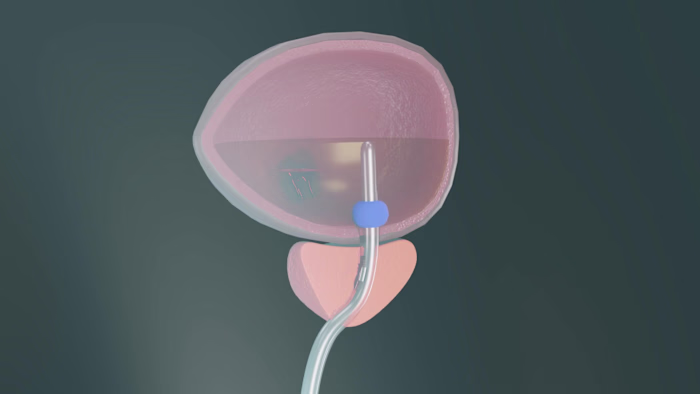 Urinary Catheter for Bladder Bleeding: 3D Medical Animation
