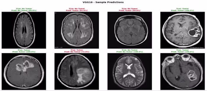Automated Brain Tumor Detection (VGG16)