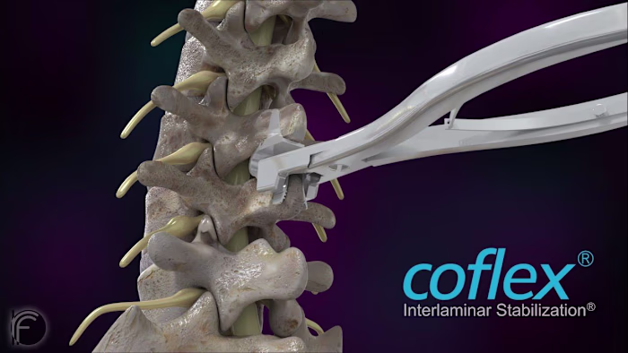 Coflex Medical Device Animation - YouTube