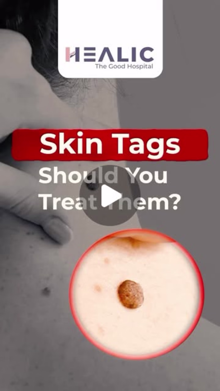 Healic Hospital on Instagram: “Noticing small, soft bumps on yo…