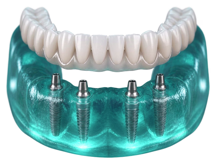 Full Mouth Dental Implants Cost 2026