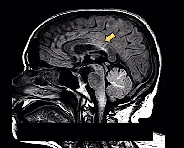 Death following rapidly progressive demyelinating disorder in a…