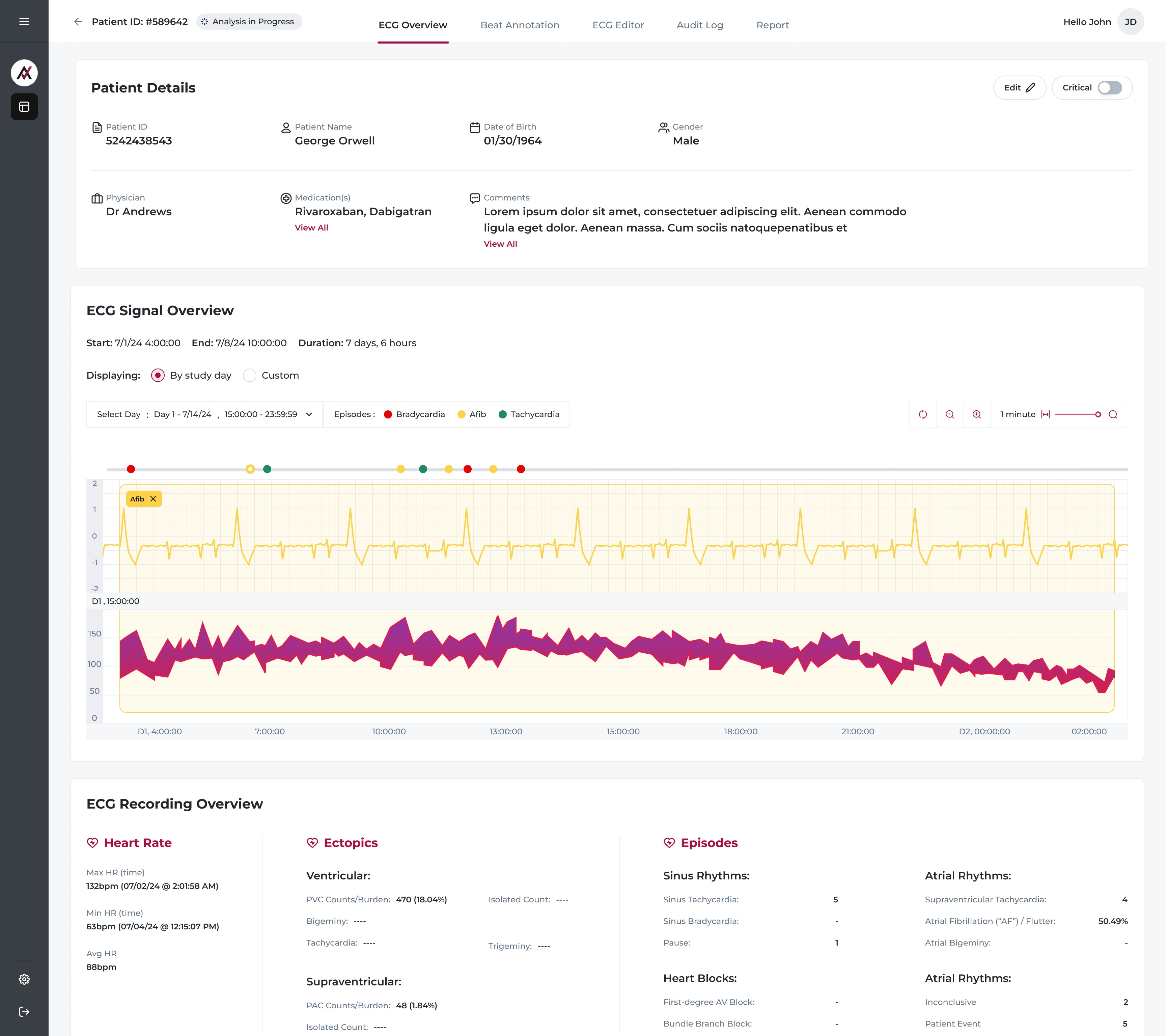 ECG Overview - Timeline Option