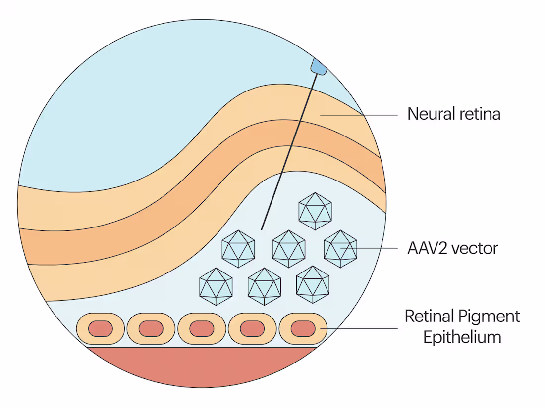 Cover image for Retinitis Pigmentosa - Gene Therapy Treatment