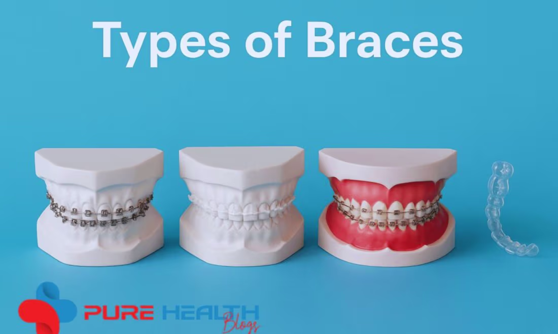 Cover image for Comprehensive Guide to Dental Braces