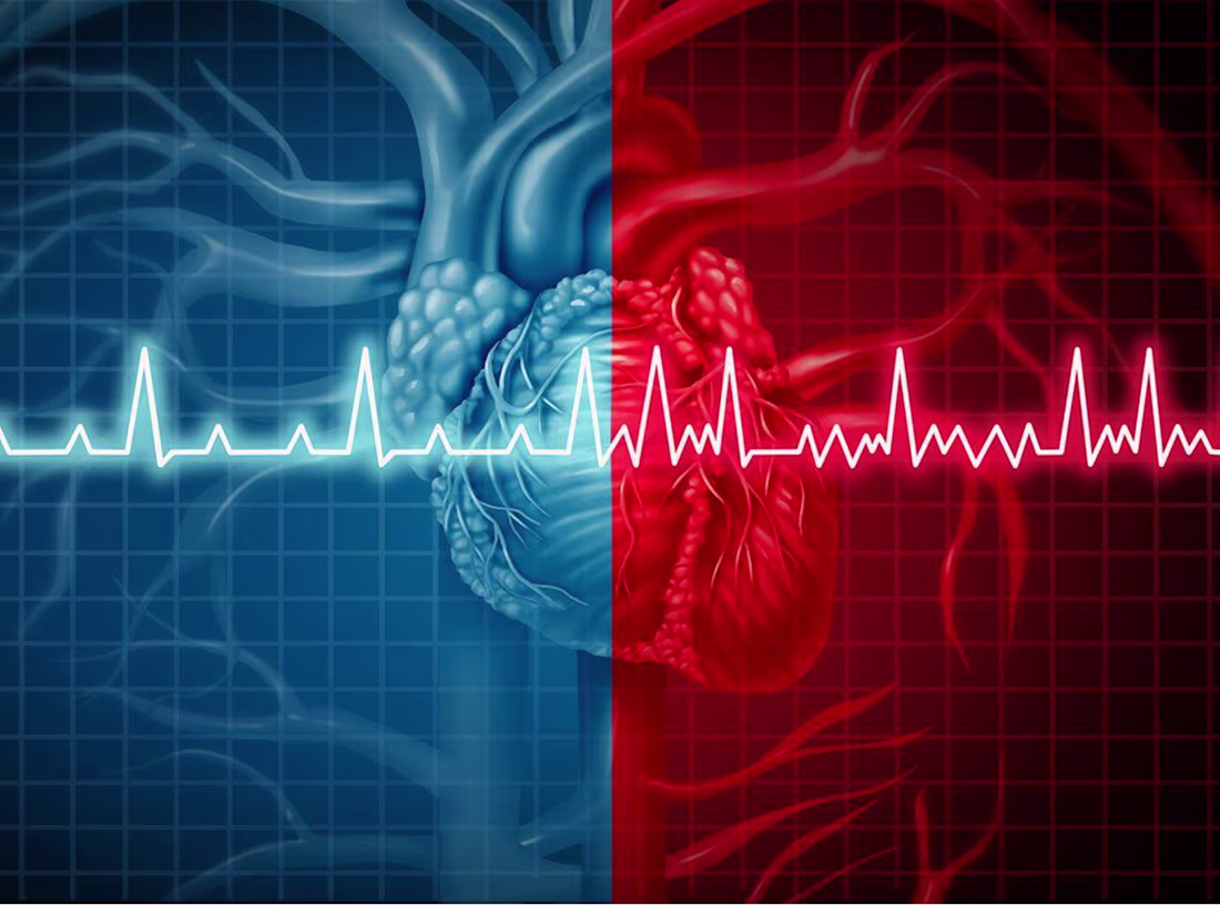 Cover image for Silent Myocardial Infarction in Diabetic Elderly Patient-