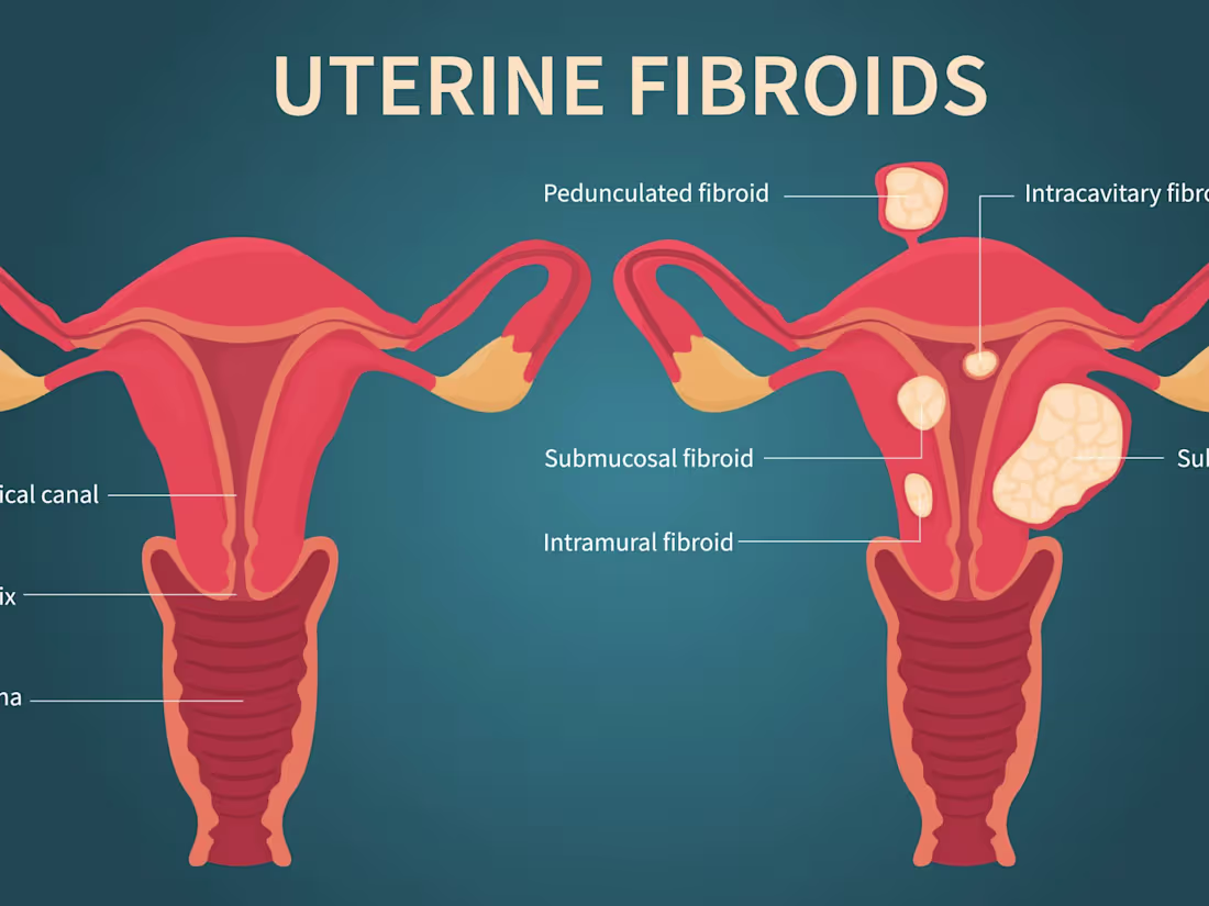 Cover image for Understanding Different Types of Fibroids 